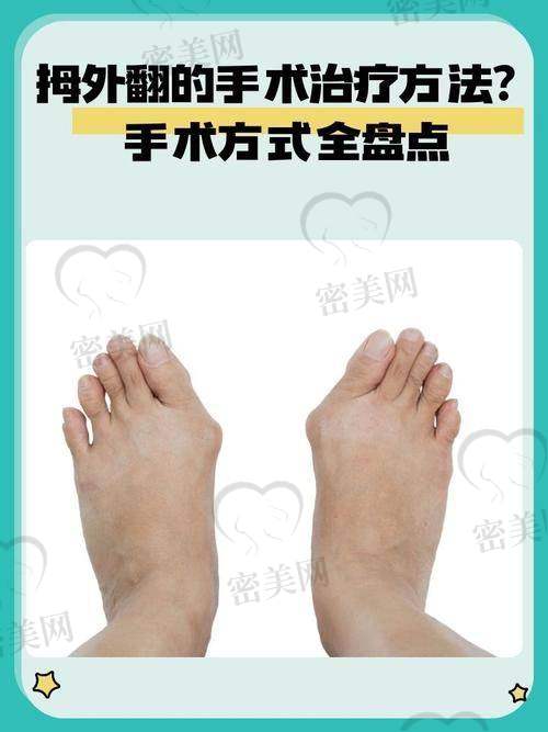 做拇外翻手术为什么选温建民医生?五大理由让你放心