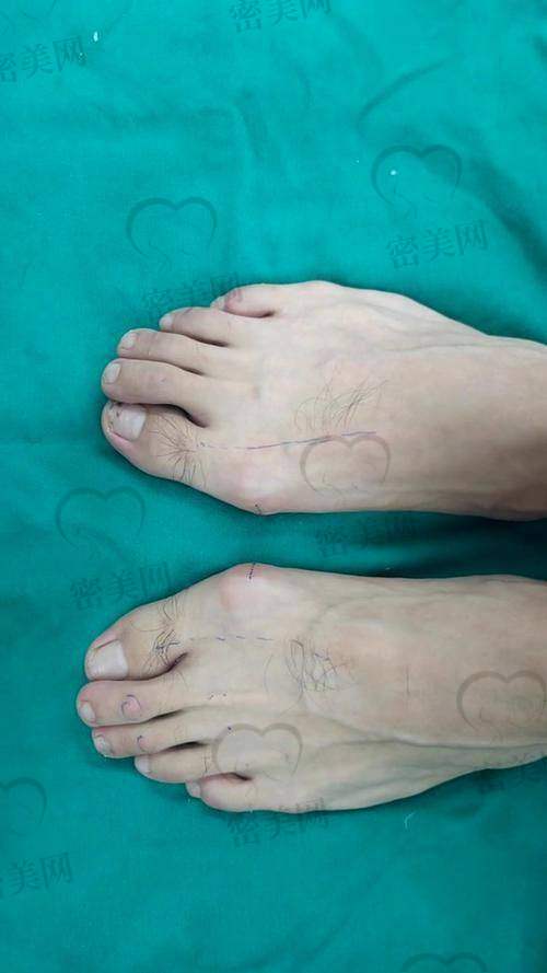 术后修复期表现:三个月养出全新脚型