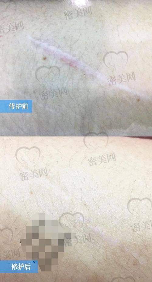 鹏程医院疤痕科的优惠活动也别错过