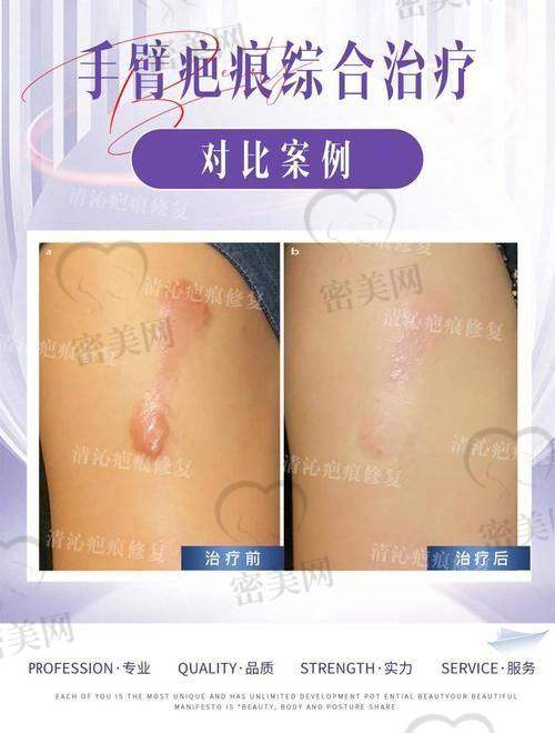 深圳鹏程医院疤痕科在哪？疤痕修复就去长虹大厦二楼