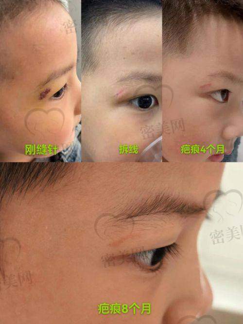 深圳鹏程医院增生疤痕治疗费用明细