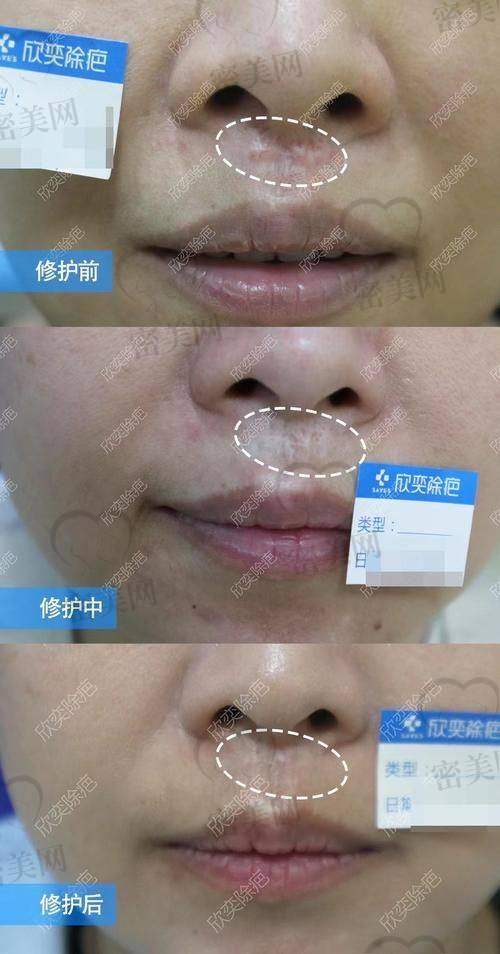 烫伤疤痕修复费用标准及推荐方案