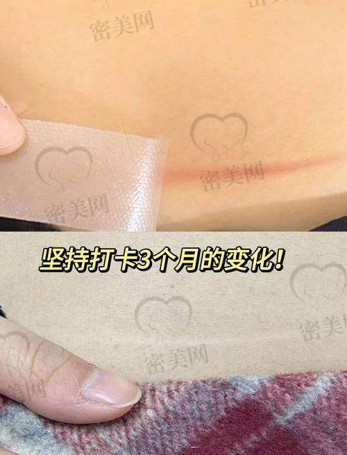 深圳鹏程医院疤痕科适合谁来？