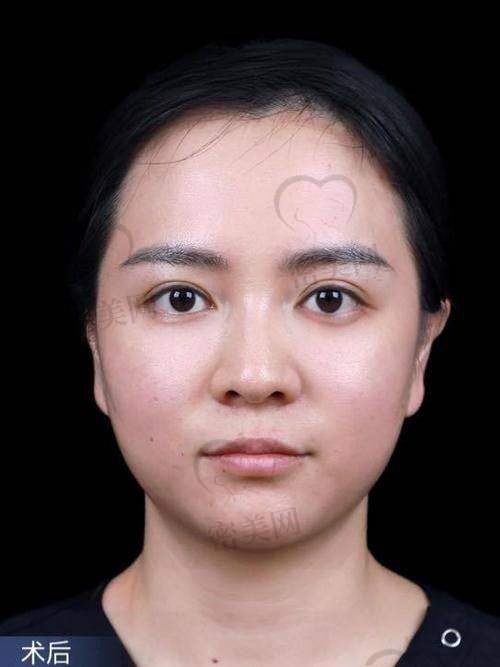 讲真,美波婷胶原丰胸多少钱?给你一份实用价格表