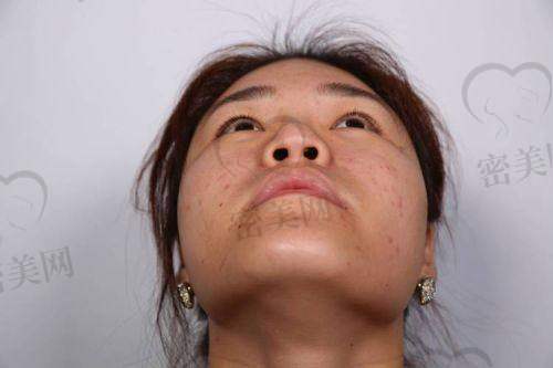 成都友谊医院 黄开亮医生:三维联动,解决鼻基底凹陷问题