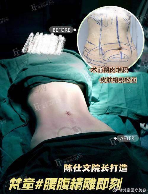 哪些人适合做孙波医生的舒适吸脂?