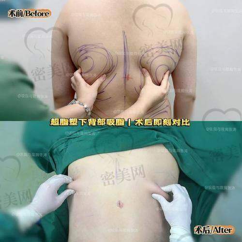 北京京韩孙波舒适吸脂技术有哪些核心优势?