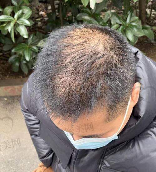 合肥曙光植发的患者评价与口碑怎么样？